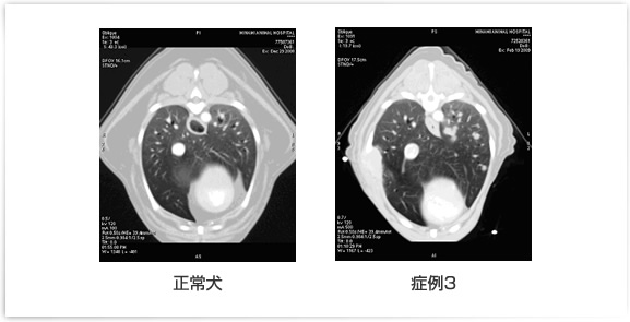 症例3:肋骨の腫瘍の肺転移